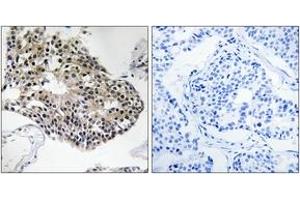 Immunohistochemistry analysis of paraffin-embedded human breast carcinoma tissue, using RPS25 Antibody. (RPS25 抗体  (AA 76-125))