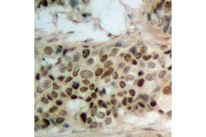 Immunohistochemical analysis of WWOX (pY33) staining in human breast cancer formalin fixed paraffin embedded tissue section. (WWOX 抗体  (N-Term, pTyr33))