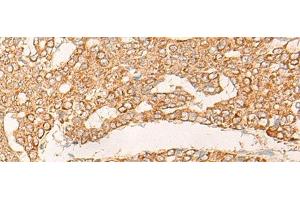 Immunohistochemistry of paraffin-embedded Human liver cancer tissue using KRT9 Polyclonal Antibody at dilution of 1:30(x200) (KRT9 抗体)