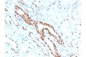 Formalin-fixed, paraffin-embedded human Renal Cell Carcinoma stained with PAX8 Mouse Monoclonal Antibody (PAX8/1491). (PAX8 抗体  (AA 60-261))