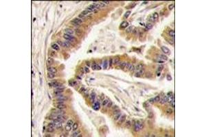 Formalin-fixed and paraffin-embedded human lung carcinoma tissue reacted with CK1a antibody (C-term), which was peroxidase-conjugated to the secondary antibody, followed by DAB staining. (CSNK1A1 抗体  (C-Term))