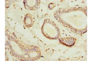 Immunohistochemistry of paraffin-embedded human breast cancer using ABIN7175449 at dilution of 1:100 (HSD17B12 抗体  (AA 40-181))