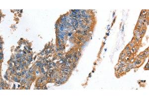 Immunohistochemistry of paraffin-embedded Human colon cancer using AKR1D1 Polyclonal Antibody at dilution of 1:35 (AKR1D1 抗体)