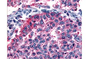 Anti-GRM6 / MGLUR6 antibody IHC of human Lung, Non-Small Cell Carcinoma. (Metabotropic Glutamate Receptor 6 抗体  (N-Term))