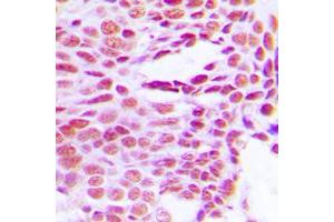 Immunohistochemical analysis of Histone H1 staining in human breast cancer formalin fixed paraffin embedded tissue section.