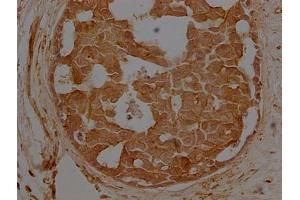 IHC image of ABIN7127368 diluted at 1:500 and staining in paraffin-embedded breast cancer performed on a Leica BondTM system. (beta Actin 抗体  (AA 1-50))