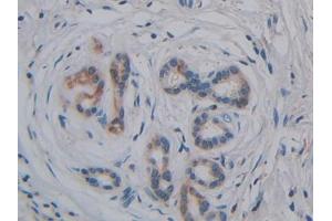 DAB staining on IHC-P;;Samples: Human Pancreatic cancer Tissue (GPLD1 抗体  (AA 496-840))