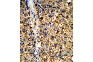 Formalin-fixed and paraffin-embedded human hepatocarcinoma reacted with GSTA2 Antibody (N-term), which was peroxidase-conjugated to the secondary antibody, followed by DAB staining.