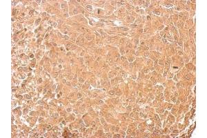 IHC-P Image GAD65 antibody detects GAD2 protein at cytosol on RT2 xenograft by immunohistochemical analysis. (GAD65 抗体  (C-Term))