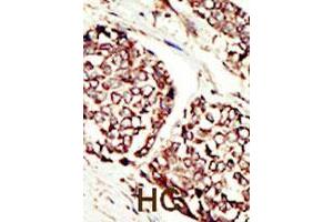 Formalin-fixed and paraffin-embedded human hepatocellular carcinoma tissue reacted with ERBB3 polyclonal antibody  , which was peroxidase-conjugated to the secondary antibody, followed by DAB staining. (ERBB3 抗体  (N-Term))