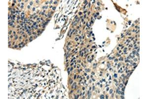 The image on the left is immunohistochemistry of paraffin-embedded Human esophagus cancer tissue using ABIN7190243(CHGB Antibody) at dilution 1/30, on the right is treated with synthetic peptide. (CHGB 抗体)