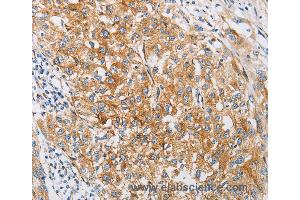 Immunohistochemistry of Human esophagus cancer using IFITM3 Polyclonal Antibody at dilution of 1:25 (IFITM3 抗体)