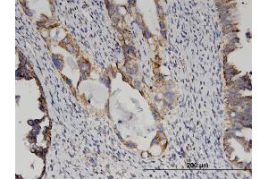 Immunoperoxidase of monoclonal antibody to GLUD2 on formalin-fixed paraffin-embedded human ovarian cancer. (GLUD2 抗体  (AA 1-264))
