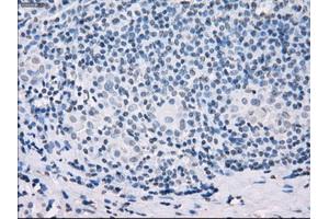 Immunohistochemical staining of paraffin-embedded Adenocarcinoma of colon tissue using anti-SSX2mouse monoclonal antibody. (SSX2 抗体)
