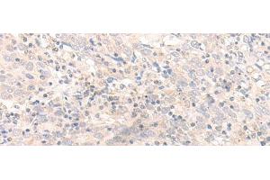 Immunohistochemistry of paraffin-embedded Human cervical cancer tissue using IL26 Polyclonal Antibody at dilution of 1:30(x200) (IL-26 抗体)