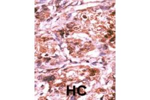 Formalin-fixed and paraffin-embedded human hepatocellular carcinoma tissue reacted with CDC25A (phospho S293) polyclonal antibody  which was peroxidase-conjugated to the secondary antibody followed by AEC staining. (CDC25A 抗体  (pSer293))