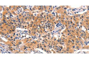 Immunohistochemistry of paraffin-embedded Human lung cancer using AMY2A Polyclonal Antibody at dilution of 1:50 (AMY2A 抗体)