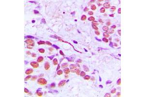 Immunohistochemical analysis of Gamma-tubulin staining in human breast cancer formalin fixed paraffin embedded tissue section. (TUBG1 抗体  (C-Term))