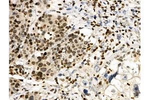 Phospho-HNF4 alpha (Ser304) Antibody at 1/100 staining Human ovarian cancer by IHC-P.