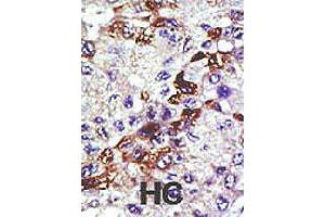 Formalin-fixed and paraffin-embedded human hepatocellular carcinoma tissue reacted with UBE2E3 polyclonal antibody  , which was peroxidase-conjugated to the secondary antibody, followed by AEC staining. (UBE2E3 抗体  (N-Term))