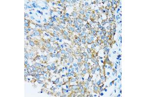 Immunohistochemistry of paraffin-embedded human lung cancer using PRDX3 antibody (ABIN5971574) at dilution of 1/100 (40x lens). (Peroxiredoxin 3 抗体)