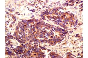 Formalin-fixed and paraffin embedded human lung carcinoma labeled with Anti-PI 3 Kinase Class 3 Polyclonal Antibody, Unconjugated (ABIN754708) at 1:200 followed by conjugation to the secondary antibody and DAB staining (PIK3C3 抗体  (AA 301-400))