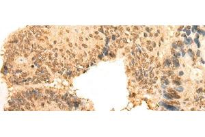 Immunohistochemistry of paraffin-embedded Human colorectal cancer tissue using CEP57 Polyclonal Antibody at dilution of 1:30(x200) (CEP57 抗体)