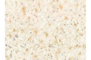 ABIN6262389 and ABIN6266906 at 1/100 staining human astrocytoma by IHC-P. (HSPH1 抗体  (C-Term))
