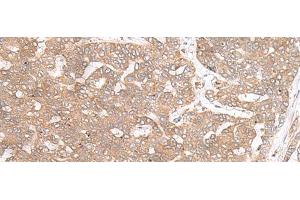 Immunohistochemistry of paraffin-embedded Human liver cancer tissue using PTP4A3 Polyclonal Antibody at dilution of 1:40(x200) (PTP4A3 抗体)