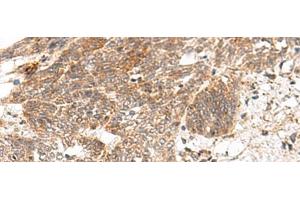 Immunohistochemistry of paraffin-embedded Human esophagus cancer tissue using GRASP Polyclonal Antibody at dilution of 1:150(x200) (Tamalin/GRASP 抗体)
