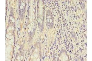 Immunohistochemistry of paraffin-embedded human colon cancer using ABIN7148658 at dilution of 1:100 (CKB 抗体  (AA 2-270))