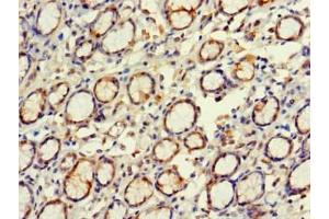 Immunohistochemistry of paraffin-embedded human gastric cancer using ABIN7152269 at dilution of 1:100 (EXD2 抗体  (AA 137-245))