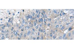 Immunohistochemistry of paraffin-embedded Human liver cancer tissue using KIAA0556 Polyclonal Antibody at dilution of 1:70(x200) (KIAA0556 抗体)