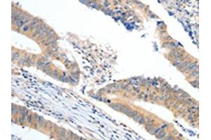 The image on the left is immunohistochemistry of paraffin-embedded Human colon cancer tissue using ABIN7189848(APOB Antibody) at dilution 1/10, on the right is treated with synthetic peptide. (APOB 抗体)