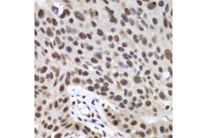 Immunohistochemistry of paraffin-embedded human lung cancer using DDX5 antibody. (DDX5 抗体  (AA 1-614))
