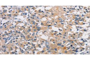 Immunohistochemistry of paraffin-embedded Human thyroid cancer using PKC epsilon Polyclonal Antibody at dilution of 1:50 (PKC epsilon 抗体)