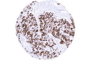 Breast Invasive breast cancer of no special type NST with variable mammaglobin immunostaining in tumor cells mosaic pattern (Recombinant Mammaglobin 抗体)