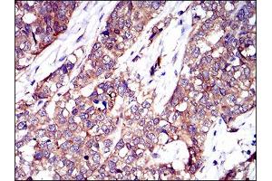 Immunohistochemical analysis of paraffin-embedded ovarian cancer tissues using TWF1 antibody with DAB staining. (TWF1 抗体  (AA 335-384))