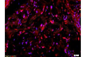 Formalin-fixed and paraffin-embedded human colon carcinoma labeled with Anti-Collagen V Polyclonal Antibody, Unconjugated (ABIN669996) 1:200 followed by conjugation to the secondary PE antibody and DAB staining