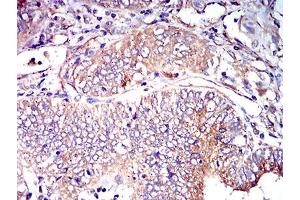 Immunohistochemical analysis of paraffin-embedded endometrial cancer tissues using CD102 mouse mAb with DAB staining.