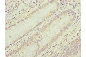 Immunohistochemistry of paraffin-embedded human colon cancer using ABIN7159903 at dilution of 1:100 (TIMM17B 抗体  (AA 1-172))