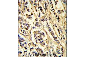 Formalin-fixed and paraffin-embedded human breast carcinoma reacted with VGFR2 Antibody, which was peroxidase-conjugated to the secondary antibody, followed by DAB staining. (VEGFR2/CD309 抗体)