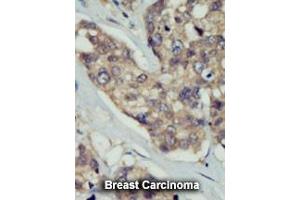 Formalin-fixed and paraffin-embedded human cancer tissue reacted with the primary antibody, which was peroxidase-conjugated to the secondary antibody, followed by DAB staining. (DOK5 抗体  (C-Term))