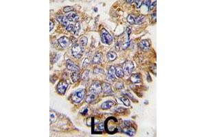 Formalin-fixed and paraffin-embedded human lung carcinoma tissue reacted with GRB2 polyclonal antibody  , which was peroxidase-conjugated to the secondary antibody, followed by DAB staining. (GRB2 抗体  (Tyr209))