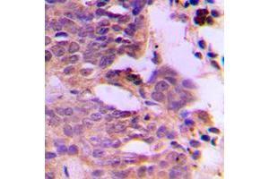 Immunohistochemical analysis of SIAH1/2 staining in human breast cancer formalin fixed paraffin embedded tissue section. (SIAH1/2 抗体  (Center))