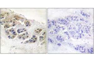 Immunohistochemistry analysis of paraffin-embedded human breast carcinoma tissue, using Mammaglobin Antibody. (Mammaglobin 抗体  (AA 41-90))