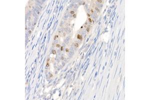 Immunohistochemistry of paraffin-embedded human colon carcinoma using Survivin Rabbit pAb (ABIN6132229, ABIN6137562, ABIN6137563 and ABIN6218613) at dilution of 1:100 (40x lens). (Survivin 抗体  (AA 1-142))