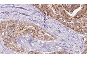ABIN6267080 at 1/100 staining Human thyroid cancer tissue by IHC-P.