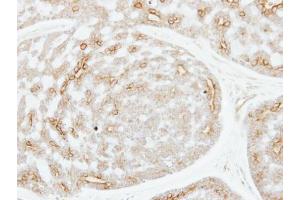 IHC-P Image Immunohistochemical analysis of paraffin-embedded human breast cancer, using ADPGK, antibody at 1:250 dilution. (ADPGK 抗体)