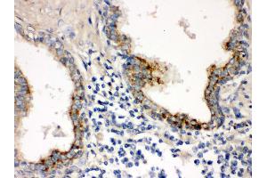 IHC(P): Human Prostatic Cancer Tissue (PTP4A2 抗体  (N-Term))